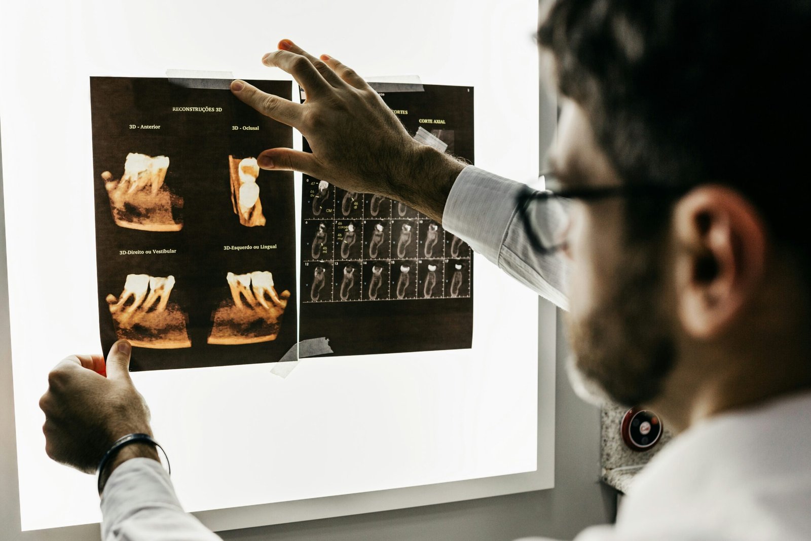 cbct for wisdom teeth montreal removal